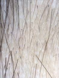 Check spelling or type a new query. Alopecia Areata Causes Treatments Breakthroughs 2020 Guide