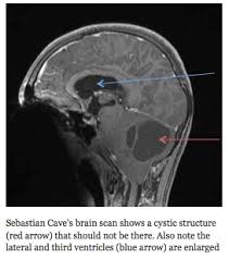 Consult your child's doctor if your child has one or more of these. Physician Resource Pediatric Brain Tumors Recognizing The Warning Signs Physician Resource