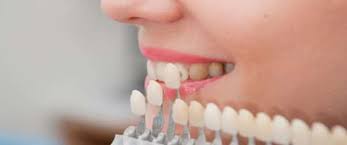 This article discussed how long dental veneers last on the teeth. How Long Do Veneers Last What You Need To Know