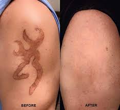 They usually tattoo this solution into the. Non Laser Tattoo Removal February 15 2018 Brannick Clinic Of Natural Medicine