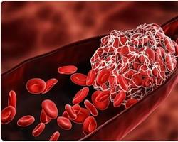 রক্ত জমাট বাঁধার সমস্যার কারণে ত্বকের নিচে রক্তক্ষরণের চিকিৎসা