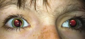 Marfan Syndrome
