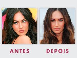 Blefaroplastia Antes E Depois Fotos E Dicas Dream Plastic