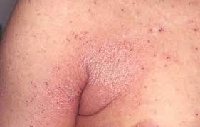 Image result for scabies effects on the human body