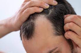 Setelah smoothing rambut, kamu sebaiknya tidak mengikat rambut terlalu kencang. 7 Cara Mudah Meluruskan Rambut Pria Yang Keriting Bukareview