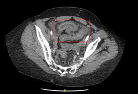 Image result for Radiation Colitis
