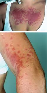 Image result for polymorphous eruption