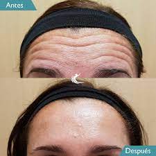 ¿a partir de que día sería lo aconsejable? Arrugas A Los 30 Botox Preventivo