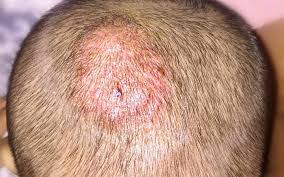 Different Scalp Conditions + Their Symptoms And Treatments – SkinKraft