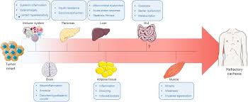 Image result for Cachexia in Cancer