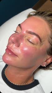 This deserved a main feed post 👏🏼 , The power of a Dermaplane + Diamond  Glow 🌟, and eyebrow wax