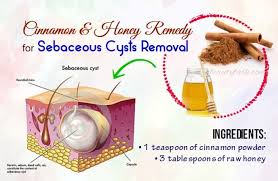 15 Remedies On How To Get Rid Of Sebaceous Cysts Naturally Cysts How To Get Rid Remedies