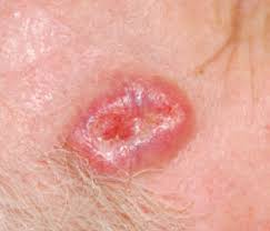 The skin cancer foundation the red patch on the ear might not look like much, but it's actually an actinic keratosis. Skin Cancer 101 A Review Of The 3 Most Common Skin Cancers