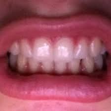 Zahnspange für erwachsene (18+) immer mehr erwachsene legen wert auf gerade und perfekte zähne. Brauche Ich Eine Zahnspange Wenn Ja Welche Zahne Zahnarzt Kieferorthopade