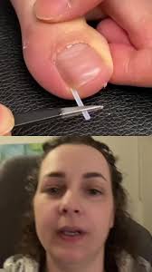 Eingewachsener Nagel Entfernen Mit Eiter