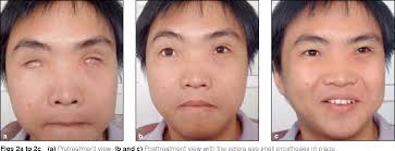 Figure 2 from Prosthetic eye rehabilitation and management of completely  blind patients.