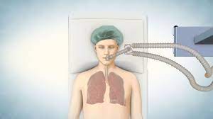 We are studying stem cell transplantation as a way to replace airways and whole lungs and to improve our. Lung Transplant Process Youtube