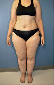 Patient Guide To Self Diagnosing Lipedema And Lipo Lymphedema