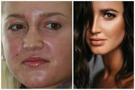 Ольга бузова — уроженка города ленинград. Byla Li Plastika U Olgi Buzovoj Foto Do I Posle Olga Buzova Do I Posle Plastiki Vse Transformacii Byvshej Blondinki I Nastoyashej Pevicy Buzova I Plasticheskie Operacii