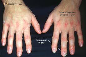 Image result for verrucae filiformes