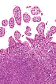 Non Hodgkin Lymphoma Wikipedia