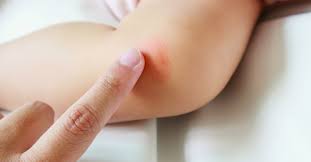 There's no one true spider bite, vetter says. What Are The Signs Of A Dangerous Bug Bite Passport Health