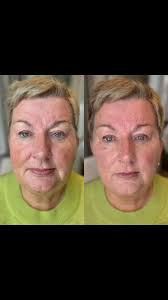 Upper face enhancement resulting in a natural, lifted and more youthful  appearance for my lovely wee client! 🫶🏻