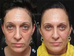 08.03.2019 · eye bag surgery is a type of eye surgery that helps improve the appearance of the area under the eye. Lower Blepharoplasty Before And After Photos Boston Eyelids