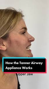 How the Tanner Airway Appliance works #tannerairwayappliance  #mouthbreathing #appliance #snoring #braces #wisdomteeth  #brainfog#airwaydentist #airway #health #smile #healthysmile #sleepapnea  #tongue ...