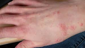 Sarna Manchas Rojas Home Remedies For Scabies Common Skin Rashes Skin Bumps