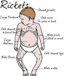 Image result for Rickets