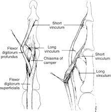 Flexor digitorum profundus tendon amputation and suturing to the extensor tendons may also lead to quadrigia and loss of digit flexion. Flexor Tendon Injury Musculoskeletal Key