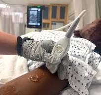 Infrared and Ultrasound for Vein Visualization | Vascular ...