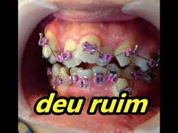 Aparelho Deixou O Dente Torto Youtube