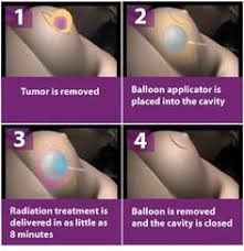 The pancreas is a bodily organ that few people think about. 530 Radiation Therapy Ideas Radiation Therapy Radiation Cancer