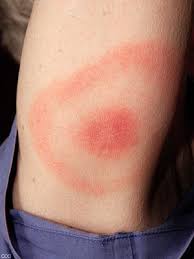 Bites That Look Like Mosquito Bites Ouch What Bug Bit Me Bug Bites Lyme Disease Fever Symptoms