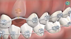 Learn more about how long it takes to put braces on? Impacted Canines At Oral Surgery Hawaii