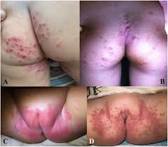 Image result for diaper dermatitis