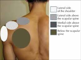 In contrast, in areas that have been developed by humans where the natural resiliency of ecosystems has been lost, floods can be very destructive. The 4 Areas Of Sensory Disturbance The Lateral Side Of The Shoulder Download Scientific Diagram