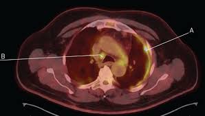 Pleural mesothelioma is a type of cancer caused by inhaling asbestos fibers. Malignant Pleural Mesothelioma An Update On Investigation Diagnosis And Treatment European Respiratory Society
