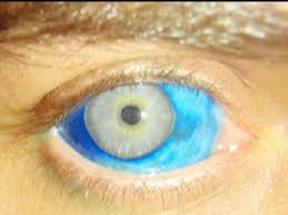 The australian said the procedure shouldn't' be dangerous but that the artist went too deep into her eyeball which ultimately caused her to lose her vision. Eyeball Tattoo Beware Of The New Trend From Usa Micro Chirurgia Oculare