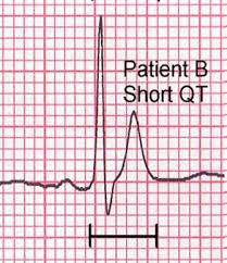 Image result for QT Interval