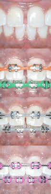 In such situations, braces are used to fit into your teeth to align the teeth in a precise manner. Gaps Between Teeth Before And After Braces Viechnicki Orthodontics