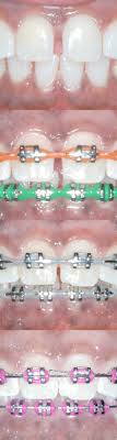 My friend suggest me a ortho flexband. Gaps Between Teeth Before And After Braces Viechnicki Orthodontics