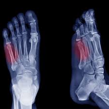 Metatarsals and phalanges of the toes are numbered 1 to 5. Understanding The Jones Fracture Of The Foot