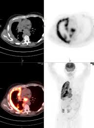 Imaging is important in diagnosing mesothelioma.it will provide information such as the extent of disease in the original organ and also show if the cancer has spread to. Mesothelioma Nuclearmd