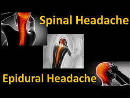Image result for Spinal Headache