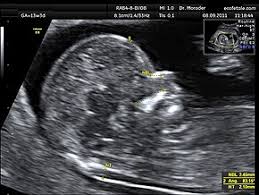 The time frame can depend on the state and area in which a person undergoes testing. Nuchal Scan Wikipedia