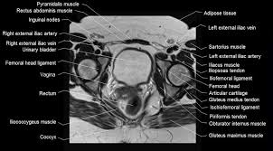 Mri Female Pelvis Anatomy Axial Im1age 2 Pelvis Anatomy Pelvis Hip Anatomy