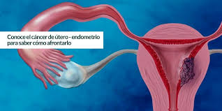 Sarcoma uterino, cáncer de endometrio y cáncer de cuello de útero. Conoce El Cancer De Utero Endometrio Para Saber Como Afrontarlo